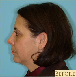 Facelift Before & After Patient #206