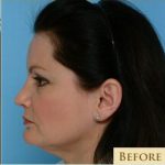Blepharoplasty Before & After Patient #2770