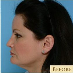 Facelift Before & After Patient #213