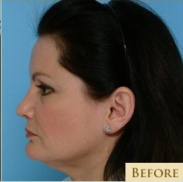 Facelift Before & After Patient #213