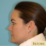 Blepharoplasty Before & After Patient #221