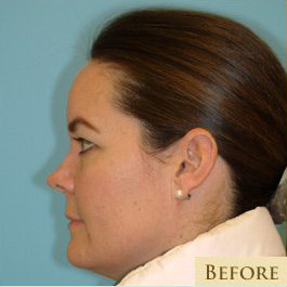 Blepharoplasty Before & After Patient #221