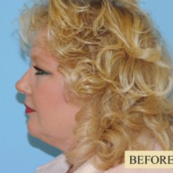 Facelift Before & After Patient #228