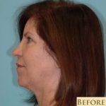 Facelift Before & After Patient #235