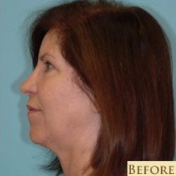 Facelift Before & After Patient #235