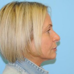 Facelift Before & After Patient #242