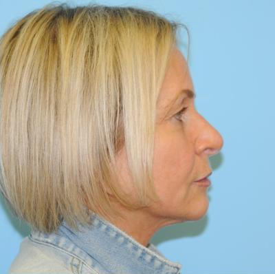 Facelift Before & After Patient #242