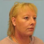 Facelift Before & After Patient #256