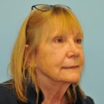 Facelift Before & After Patient #263