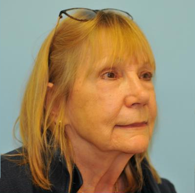 Facelift Before & After Patient #263