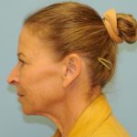 Facelift Before & After Patient #2766