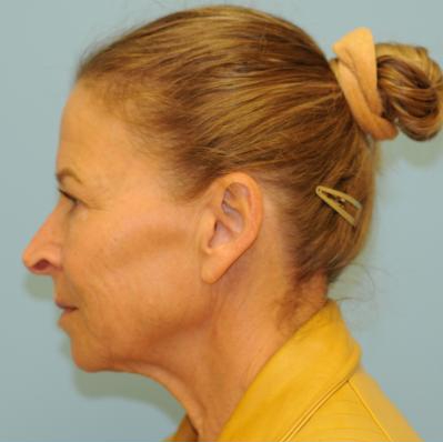 Facelift Before & After Patient #270