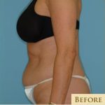 Abdominoplasty Before & After Patient #87