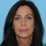 Facelift Before & After Patient #277