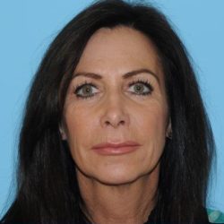 Facelift Before & After Patient #277