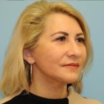 Facelift Before & After Patient #284