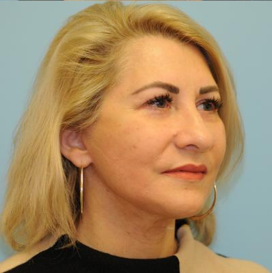 Facelift Before & After Patient #284