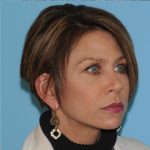 Facelift Before & After Patient #298