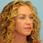 Blepharoplasty Before & After Patient #312