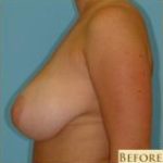 Breast Reduction Before & After Patient #333