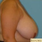 Breast Reduction Before & After Patient #340