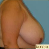 Breast Reduction Before & After Patient #340
