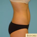 Abdominoplasty Before & After Patient #94
