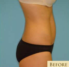 Abdominoplasty Before & After Patient #94