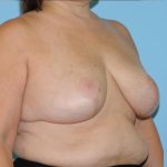 Breast Reduction Before & After Patient #382