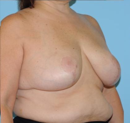 Breast Reduction Before & After Patient #382