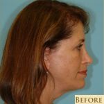 Facelift Before & After Patient #396