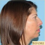 Facelift Before & After Patient #410