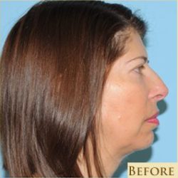 Facelift Before & After Patient #410