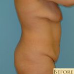 Abdominoplasty Before & After Patient #101
