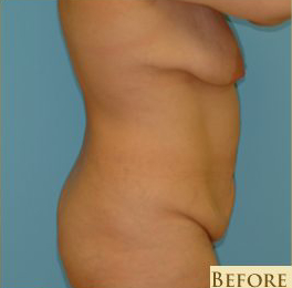 Abdominoplasty Before & After Patient #101