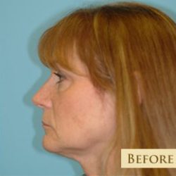 Facelift Before & After Patient #417