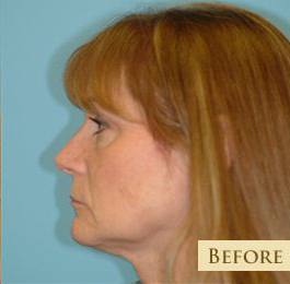 Facelift Before & After Patient #417