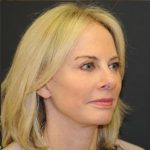 Facelift Before & After Patient #445