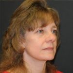 Facelift Before & After Patient #452