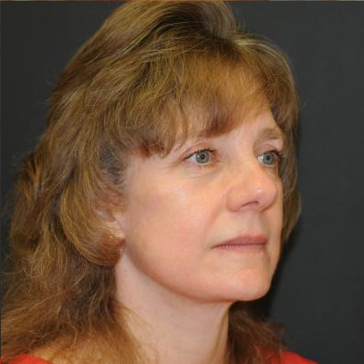 Facelift Before & After Patient #452