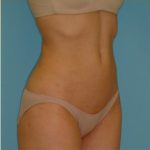 Liposuction Before & After Patient #473
