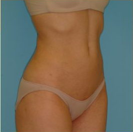 Liposuction Before & After Patient #473