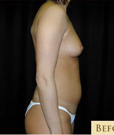 Liposuction Before & After Patient #480
