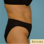 Abdominoplasty Before & After Patient #108