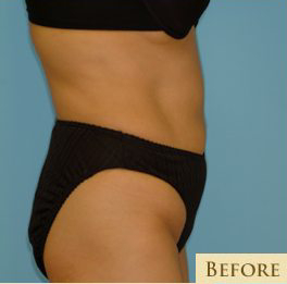 Abdominoplasty Before & After Patient #108
