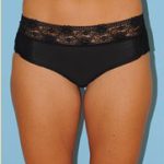 Liposuction Before & After Patient #487