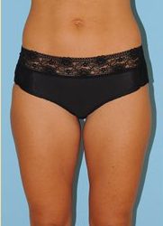 Liposuction Before & After Patient #487