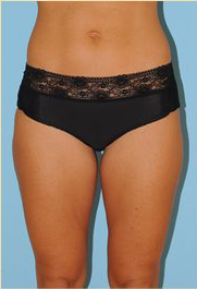 Liposuction Before & After Patient #487