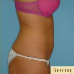 Liposuction Before & After Patient #492