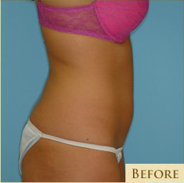 Liposuction Before & After Patient #492